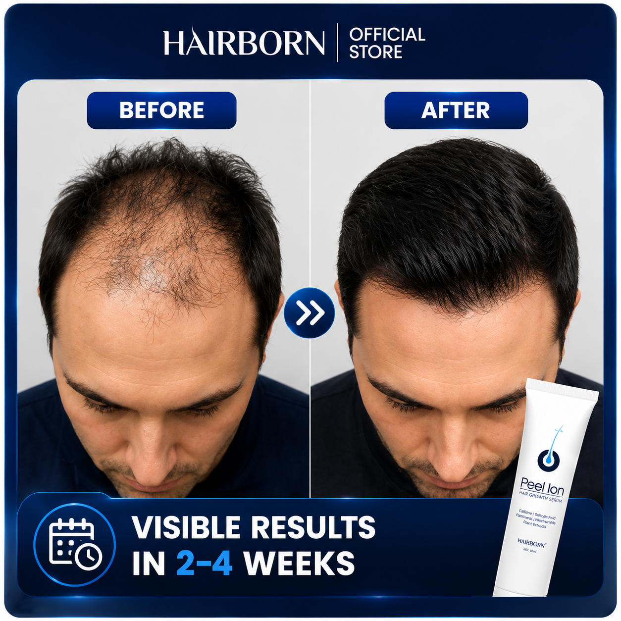 HairBorn™ Peel ion - Hair Regrowth Serum