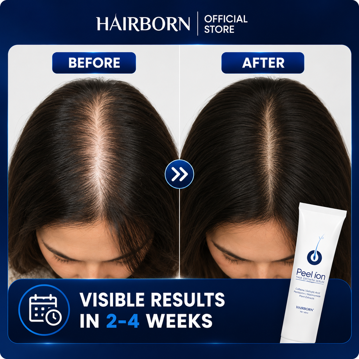 HairBorn™ Peel ion - Hair Regrowth Serum