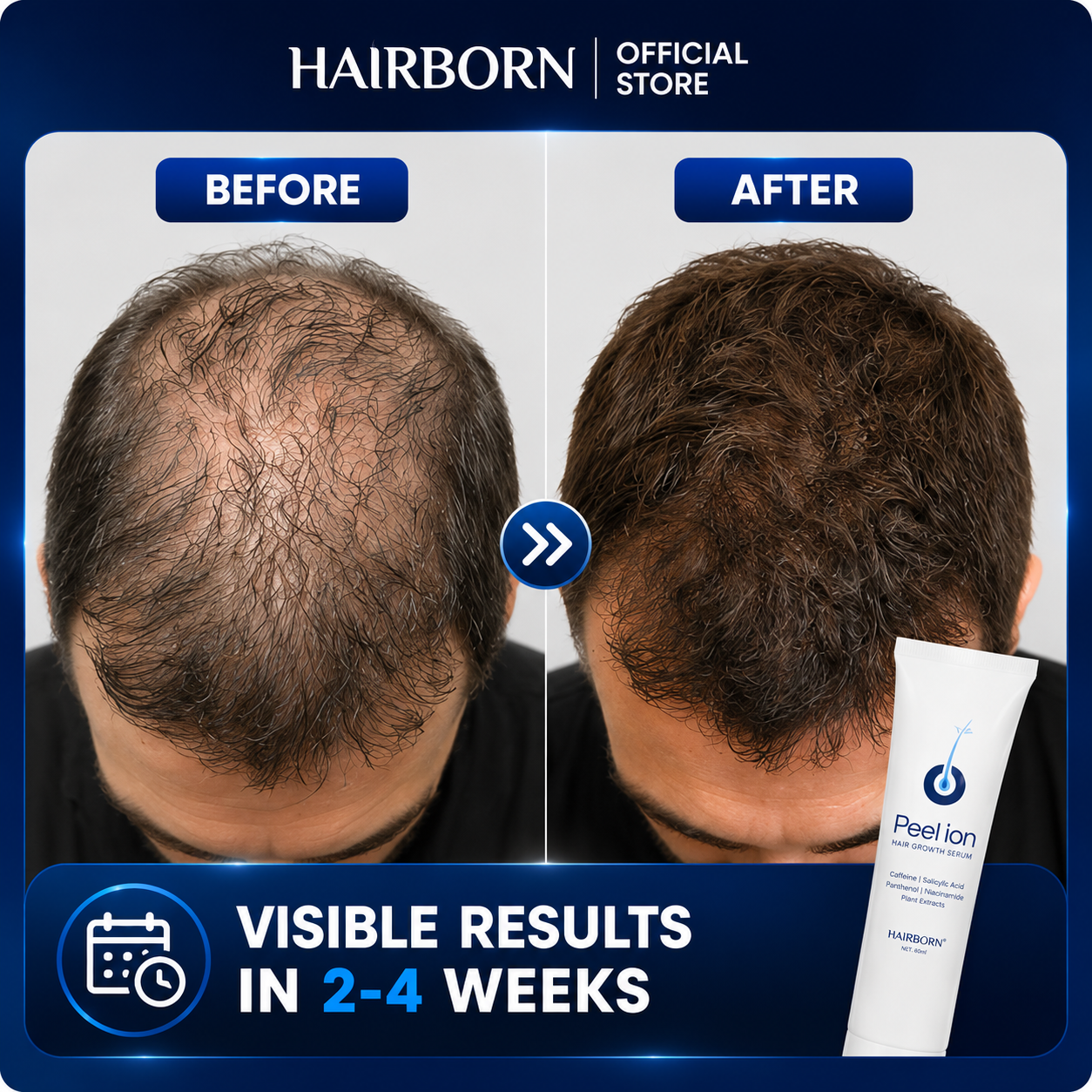 HairBorn™ Peel ion - Hair Regrowth Serum