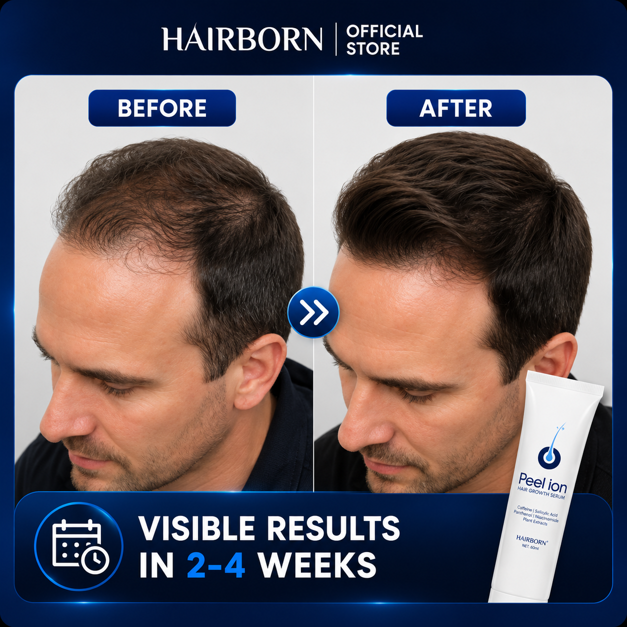 HairBorn™ Peel ion - Hair Regrowth Serum